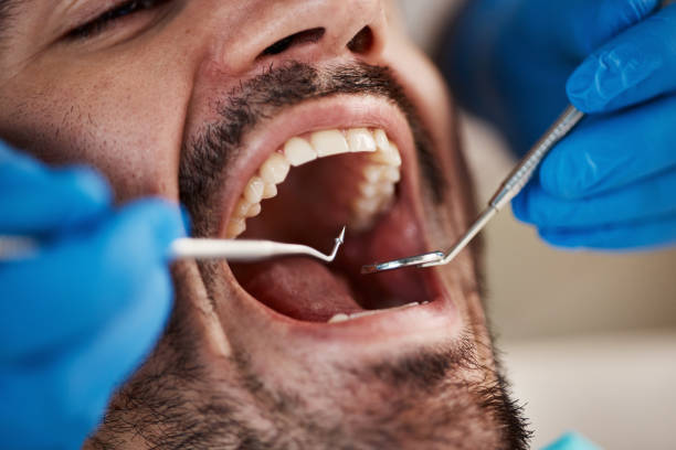 Best Emergency Dental Care for Sports Injuries in New Franklin, MO