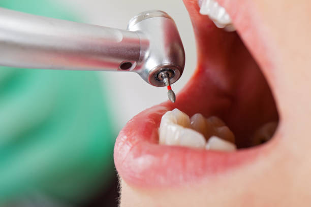 Best Emergency Wisdom Tooth Extraction in New Franklin, MO